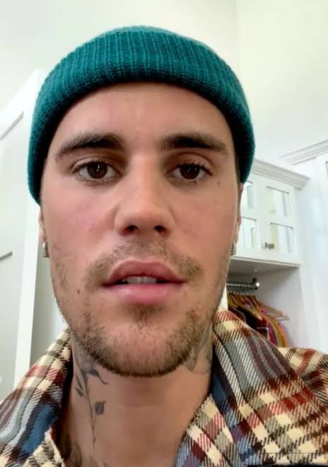 What is Ramsay Hunt syndrome, the virus attacking Justin Bieber’s face?